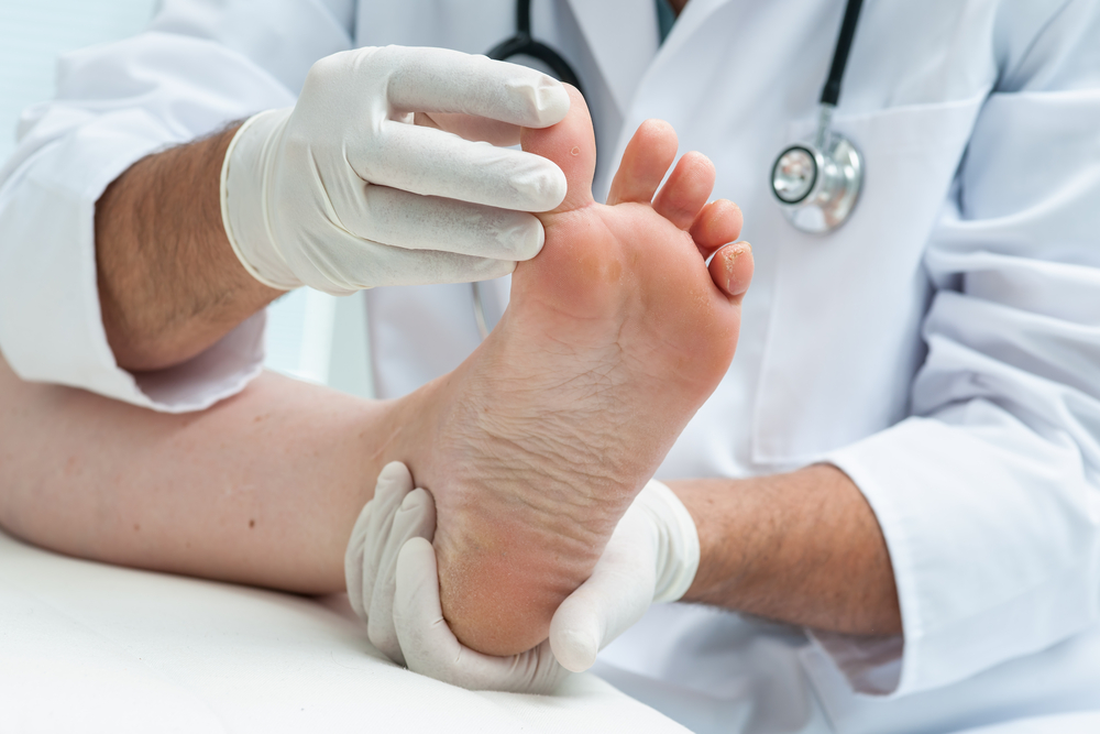 How Can Your Doctor Help Get Rid of Athlete’s Foot?