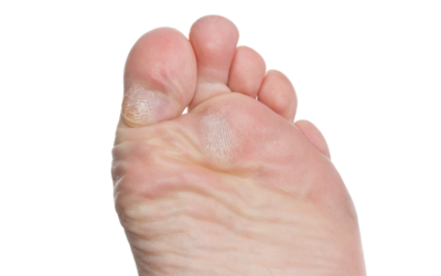 What Is the Difference Between Corns and Calluses?