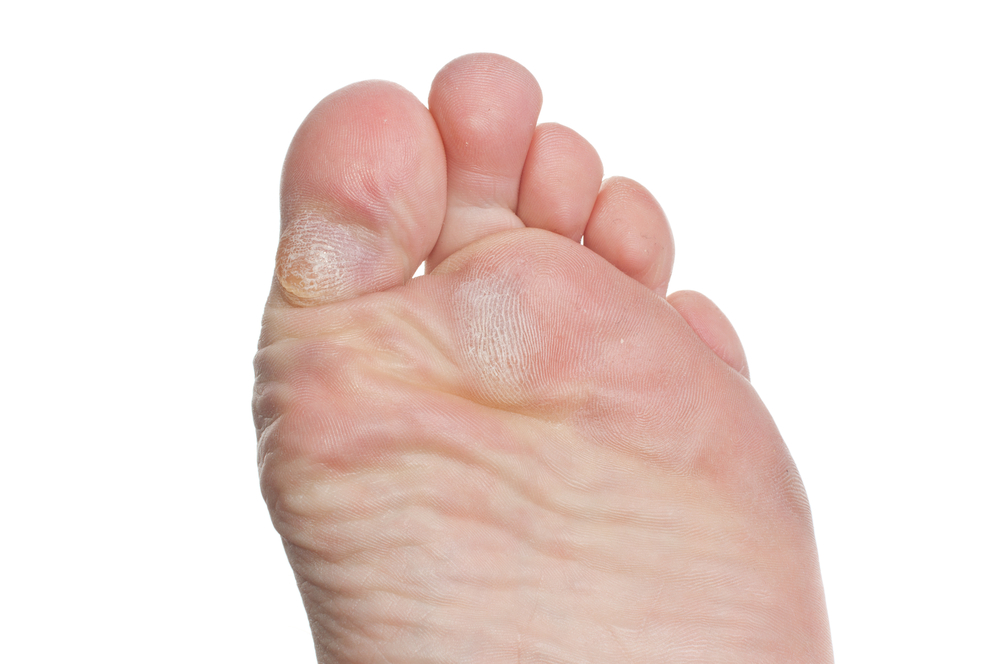 What Is the Difference Between Corns and Calluses?