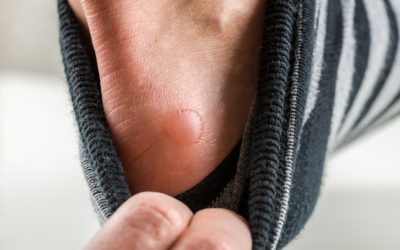 7 Ways a Foot Doctor Can Treat Painful Blisters