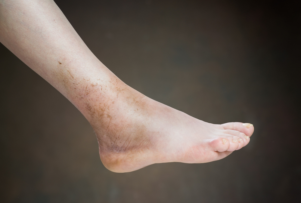 Ask a Foot Doctor: How Can You Tell If a Sprain Is Serious?