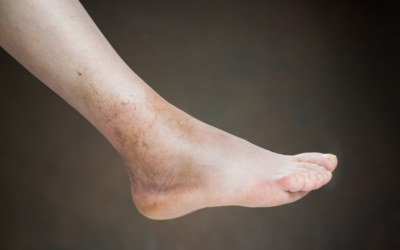 Ask a Foot Doctor: How Can You Tell If a Sprain Is Serious?