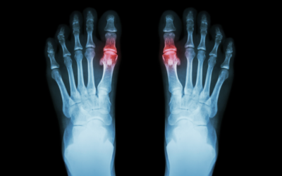 Ask a Foot Specialist: Will I Need Surgery for a Metatarsal Injury?