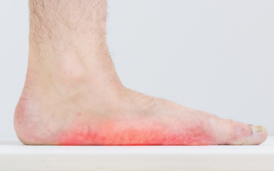 8 Things You Can Do to Help Correct Flat Feet