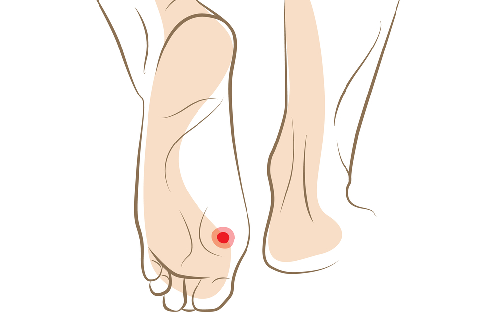 When Should You Seek Treatment for Corns and Calluses?