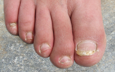 Ask a Foot Doctor: What Causes Thick or Discolored Toenails?
